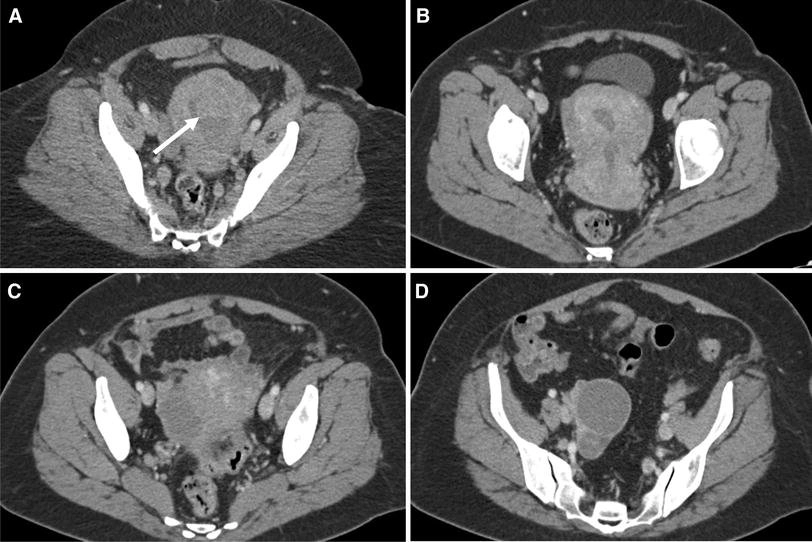 تصویر برداری پس از یک جراحی ناموفق ابلیشین آندومتر و بررسی دلایل