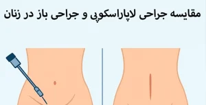 مقایسه جراحی لاپاراسکوپی و جراحی باز در زنان لوگو