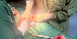 روش‌های جراحی آندومتریوز پیشرفته لوگو