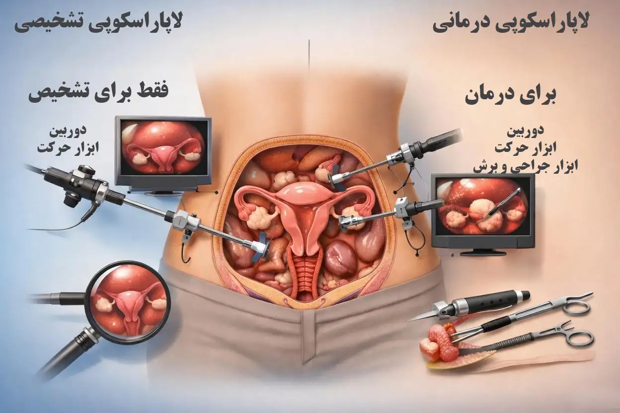 تفاوت لاپاراسکوپی تشخیصی و درمانی در زنان