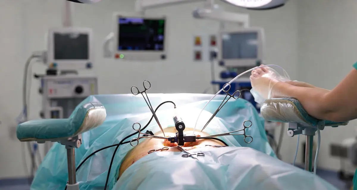 عمل لاپاراسکوپی هیسترکتومی